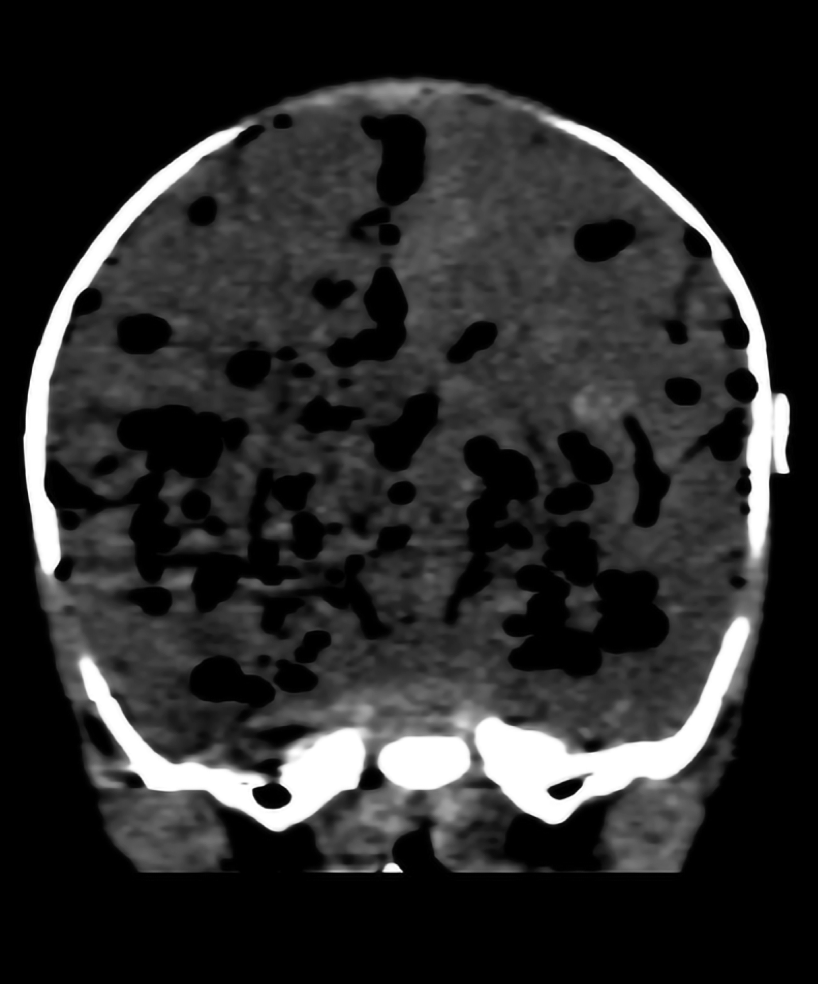 NICU_Musings's tweet photo. Pneumocephalus in a 30 week #preemie infected with citrobacter koseri
Died at 17 days of age from destruction of brain tissue.
3D color reconstruction: air collections in grey/black.
At autopsy: gush of air heard upon entering the cranial vault
https://t.co/y2uiO9jBaR
#neotwitter https://t.co/uipuwmNeJ9