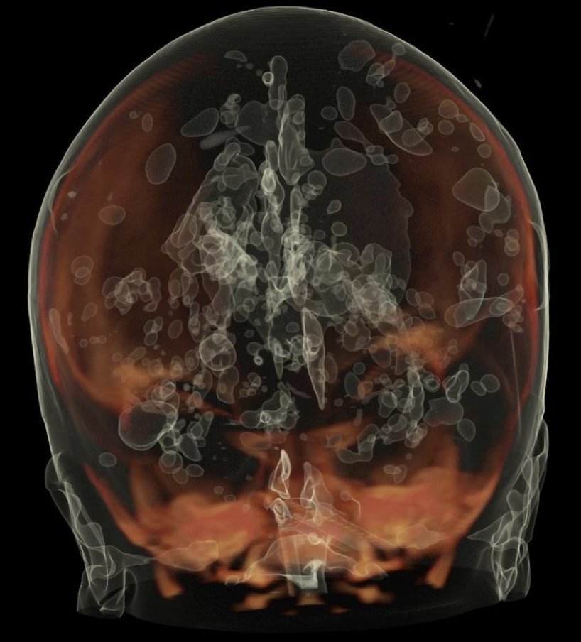 NICU_Musings's tweet photo. Pneumocephalus in a 30 week #preemie infected with citrobacter koseri
Died at 17 days of age from destruction of brain tissue.
3D color reconstruction: air collections in grey/black.
At autopsy: gush of air heard upon entering the cranial vault
https://t.co/y2uiO9jBaR
#neotwitter https://t.co/uipuwmNeJ9