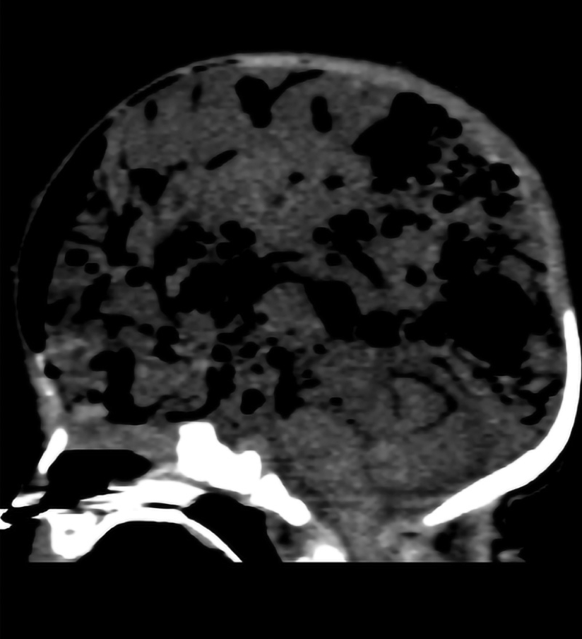 NICU_Musings's tweet photo. Pneumocephalus in a 30 week #preemie infected with citrobacter koseri
Died at 17 days of age from destruction of brain tissue.
3D color reconstruction: air collections in grey/black.
At autopsy: gush of air heard upon entering the cranial vault
https://t.co/y2uiO9jBaR
#neotwitter https://t.co/uipuwmNeJ9
