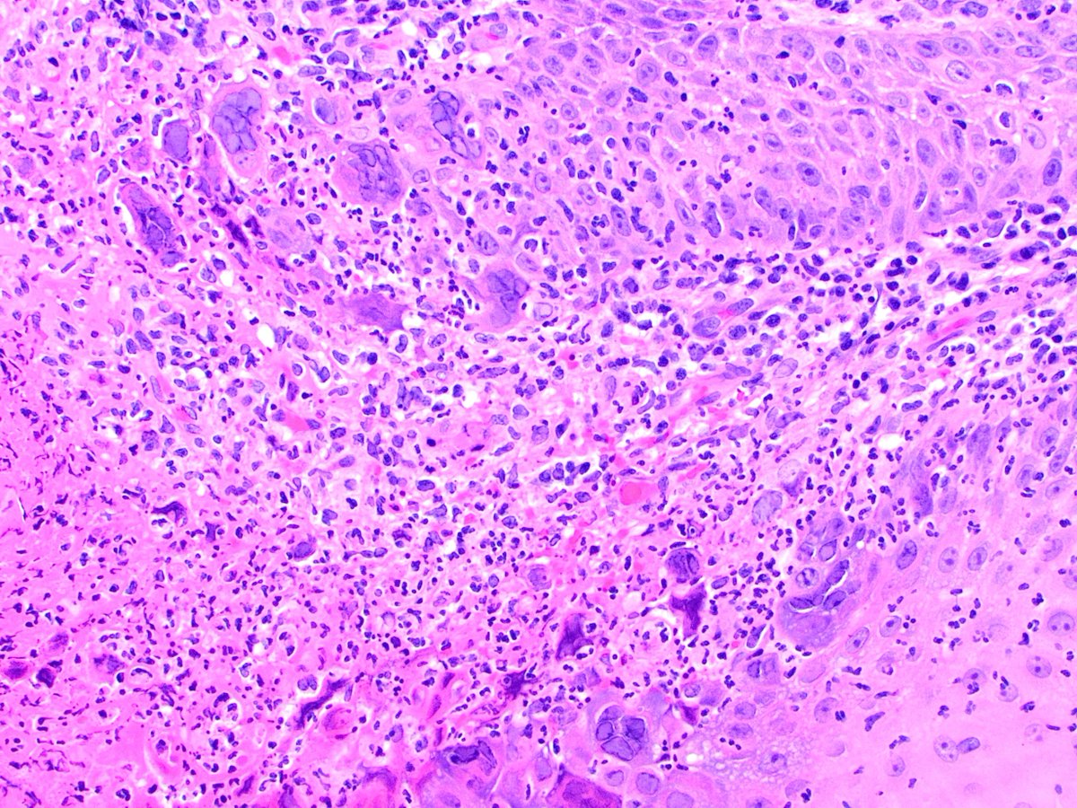 PathologyUSAH's tweet photo. ๐ฌWeekend head scratcher:
A hypertrophic and ulcerated anal lesion was excised with concerns for malignancy.
Diagnosis? or diagnoses?
#PathX #PathTwitter #MedTwitter #PathRes https://t.co/BHe0o9o4F1