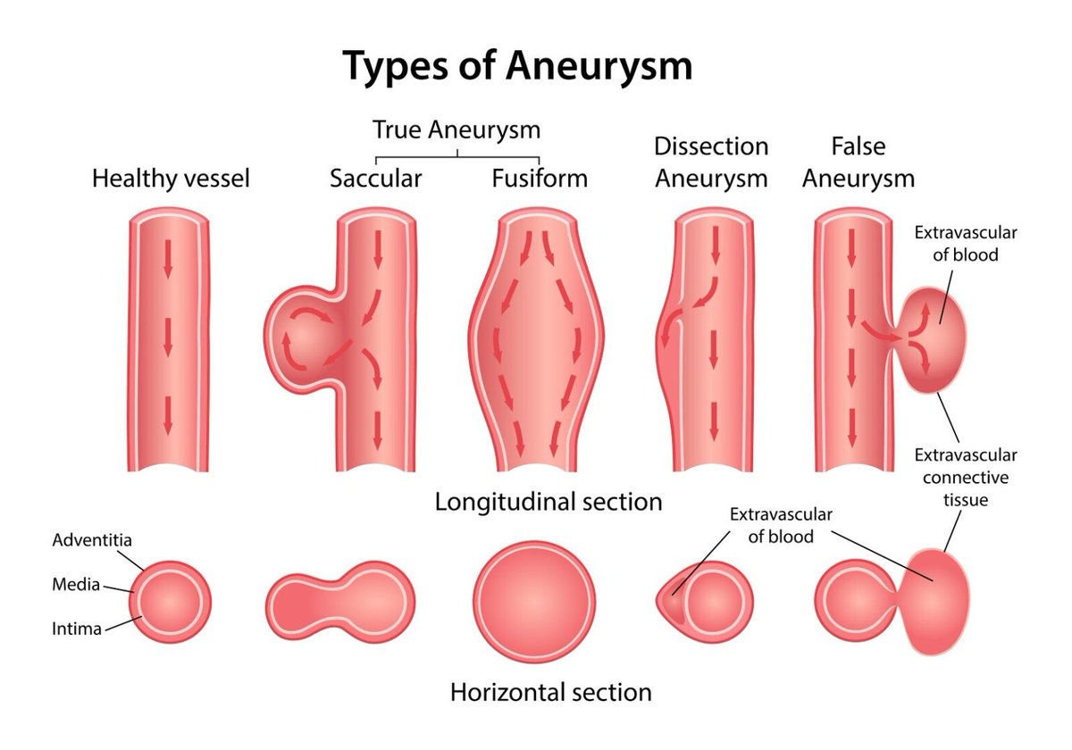 Types of Aneurysm
