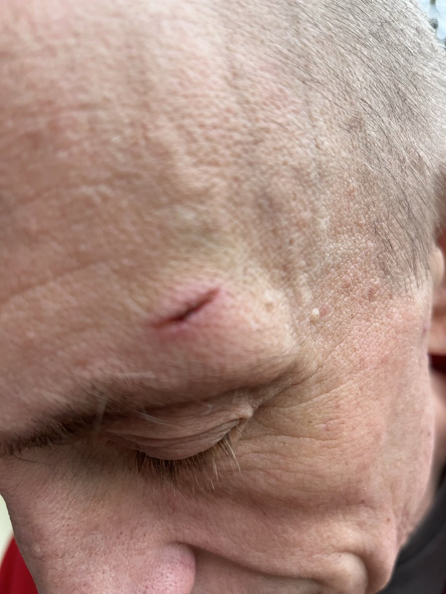 Six months after my capture, I was finally exchanged.
Beaten, emaciated and tortured right up until the last day.

These photos were taken the first day after my transfer, safely back in the UK.

Electric cattle prods, truncheons, beatings, all the way home.