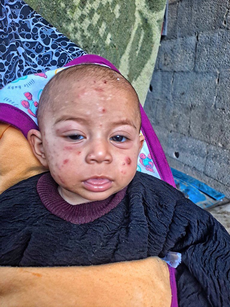 mahmoud60013's tweet photo. OUR Hearts ache for little Tasneem. Her small face is covered with rashes that keep appearing, and her eyes are swollen and tired from the severe inflammation. Every moment brings burning and itching that hurt her, and she begins to cry because her small body cannot find any relief. Even sleep no longer comforts her as it once did.  TASNEEM urgently needs treatment to relieve her pain. https://t.co/1j2ThFHP22 If you’re scrolling, PLEASE leave a dot . it's just a dot Or pray for her in a comment