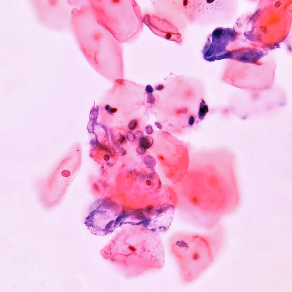 Citopatoroxx's tweet photo. HSIL
Small cells with nuclear enlargement leading to a marked increase in the nuclear to cytoplasmatic radio with very hypocromatic nuclei.
Contour of the nuclear membrane is quite irregular with indentation.
Follow up with CIN III in the biopsy.
#cytopath #PathTwitter #paptest https://t.co/GNa6rYg4PW