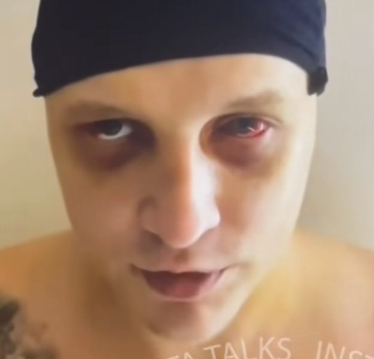 cartitweakin's tweet photo. @crypto_bitlord7 @MarioNawfal Looks like a pretty real black eye https://t.co/BStf6Koslc