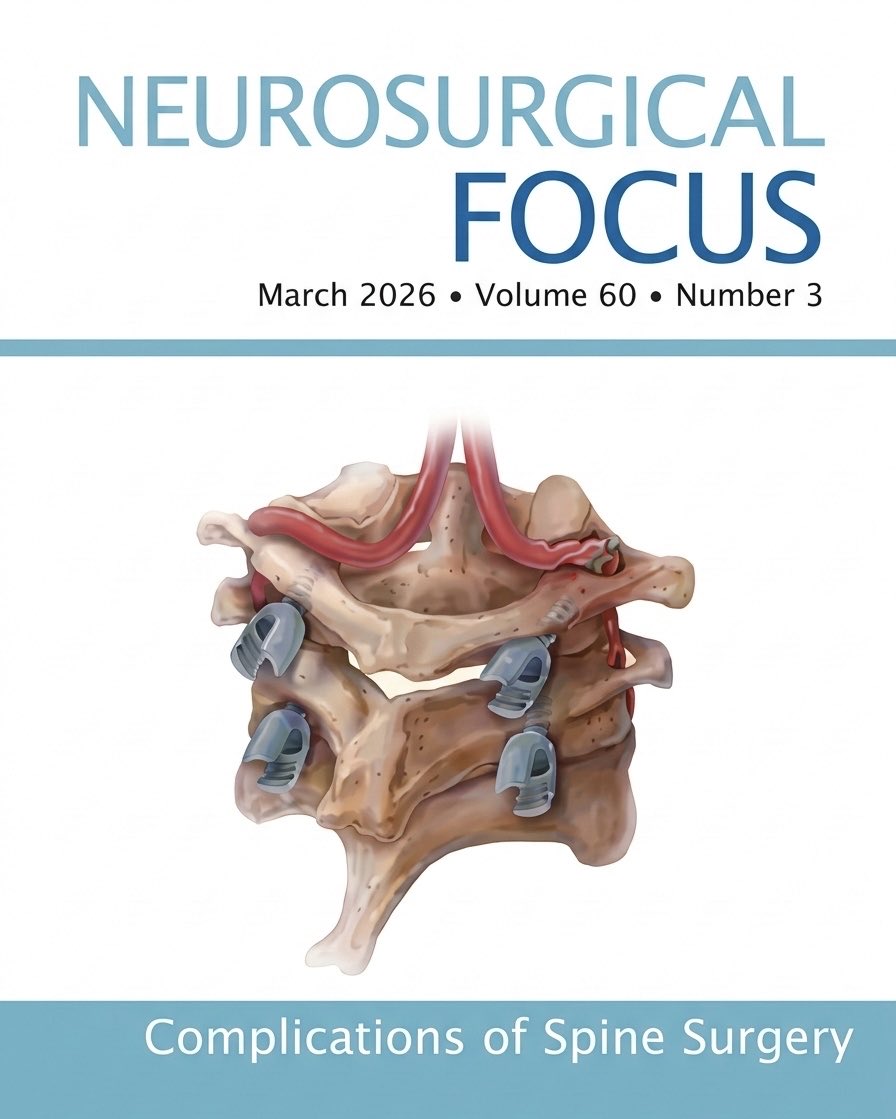 JuanPGiraldoMD's tweet photo. #Complications in Spine Surgery: Check the #MarchFocus Issue. The work collected here: from technical precision to patient safety — is not something to take lightly. Learning alot from the Masters with this one: @TheJNS. Honored to be part of these learning points. https://t.co/wrLo8qAWFC