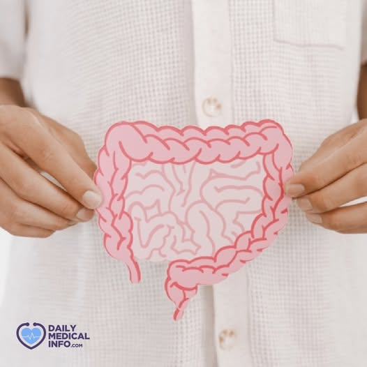 DMedicalinfo's tweet image. #سلائل_القولون هي زوائد صغيرة تنمو على بطانة القولون أو الأمعاء الغليظة، وهي جزء من الجهاز الهضمي. 
معظم هذه الزوائد تكون غير ضارة، لكن بعضها قد يتحول بمرور الوقت إلى #سرطان_القولون. لذلك يحرص الأطباء عادةً على إزالة أي سلائل يتم اكتشافها أثناء الفحص.
#colonpolyps