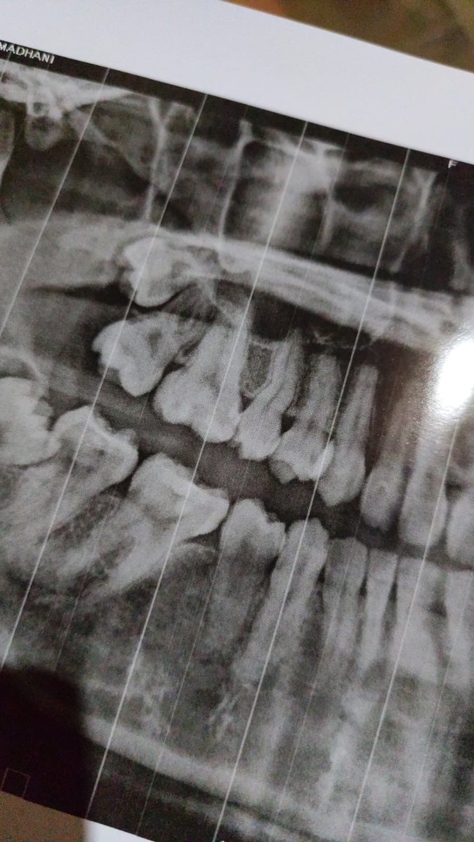 Kiamat kecil adalah saat tumbuh gigi geraham bungsu dan tumbuhnya impaksi.