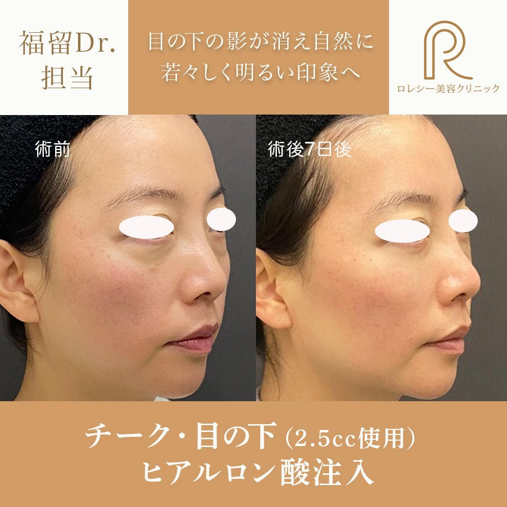 rolecy0605's tweet photo. 顔面を短縮して、理想の「大人可愛い」を作る

チーク位置が上がると、お顔の重心がグッと上へ！
のっぺり見えがちな中顔面をキュッと引き締め、小顔効果も期待できます✨

目の下のくぼみを埋めることで、光を味方にする「ツヤ玉」ラインを形成。
やりすぎ感のない、ナチュラルな美しさを追求します。 https://t.co/GwJqqL7STX