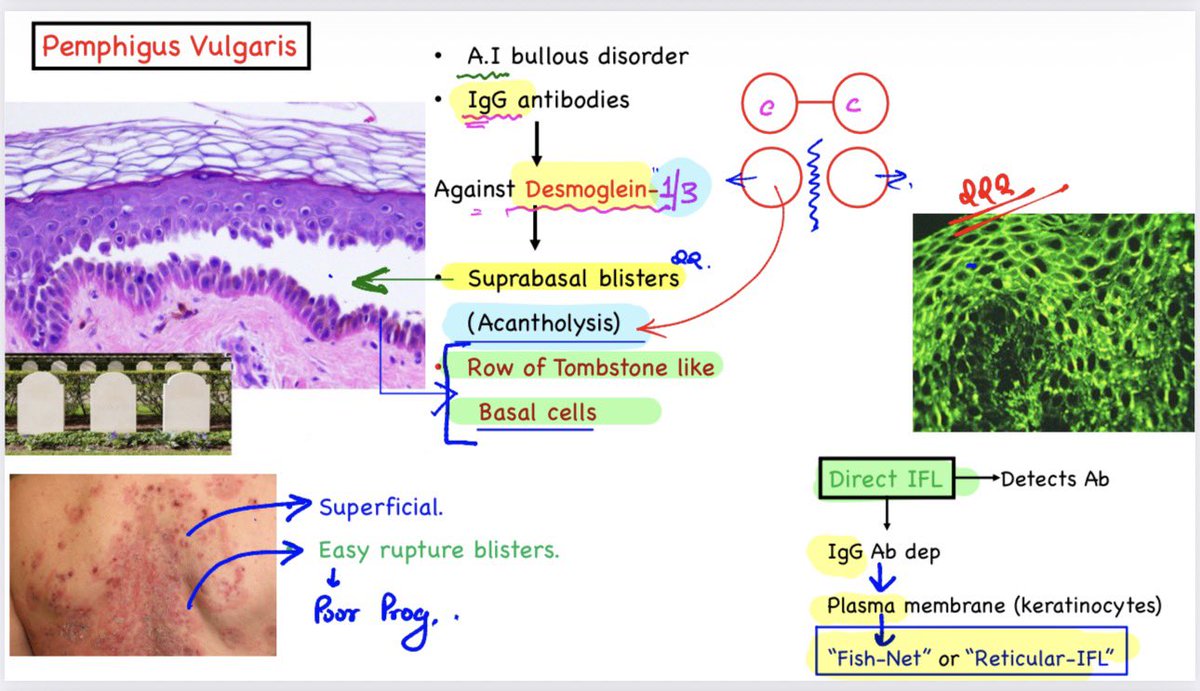 drdev555's tweet photo. 🕉 Pemphigus vulgaris:
➖➖➖➖➖➖➖➖➖➖➖➖
👉Lecture snapshot from “Integrated Concepts of Pathology” By Dr. Devesh Mishra 👍
👉Build Concepts.
👉Strengthen Clinical Thinking.
👉Succeed with Clarity.
#drdeveshmishra #dpma #neetpg #fmge #inicet https://t.co/MzuZBt09nc