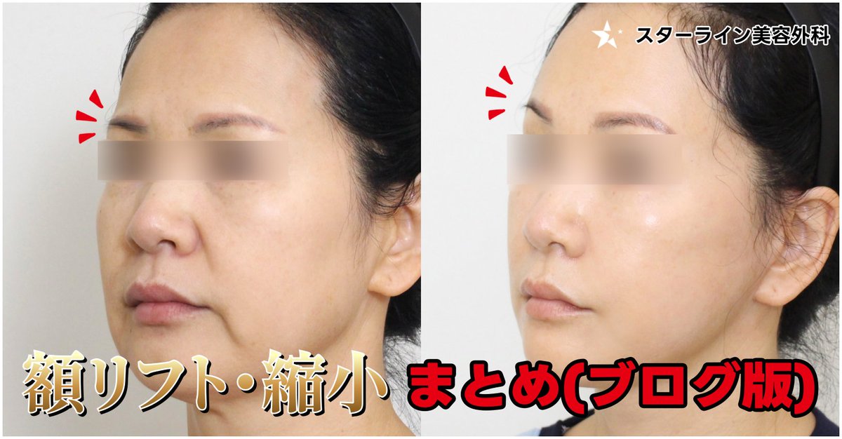 【切開リフト・脂肪吸引専門】 スターライン美容外科 tweet media