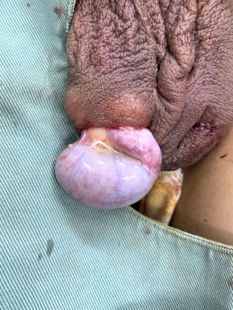 阴茎缩短术Penile skin castration tweet media