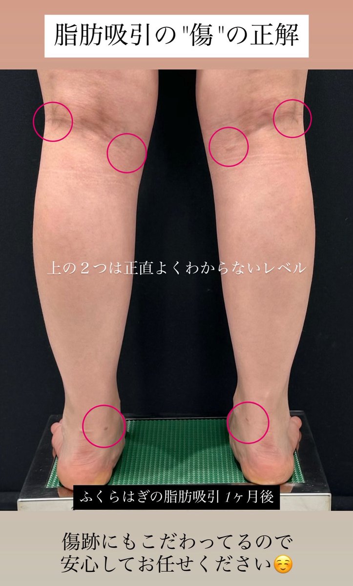 dr_gibo_'s tweet photo. 【ふくらはぎの脂肪吸引が難しい4つの理由】

①適応の見極め
ふくらはぎの太さは筋肉がメインのことがほとんど。筋肉が少ない or BTXで小さくしたけどさらに細くしたい方向け。

②脂肪が少ない
麻酔液(チュメセント)や吸引管(選択とタイミング)がうまくないとボコつく。浅いところ攻めすぎると色素沈着しやすい。いわゆる"カリカリ"には向かない場所。吸引の経験値がモロに出る。

③傷がきれいになりにくい
傷の位置がキモ(2枚目のようにしわに沿ったエントリーポイント、縫合の丁寧さ次第で目立たなくはできる)。足首の傷は膝裏に比べてどうしても目立ちやすい(血流の問題)。

④合併症リスクが高い
小伏在静脈や表在リンパ管があるので内出血(→ヘモジデリン沈着で長期の色素沈着になることも)、長期間の浮腫などが起こりうる。解剖を意識した吸引、丁寧な手術操作である程度は防げる。

ベストな治療をしますのでお任せください💪