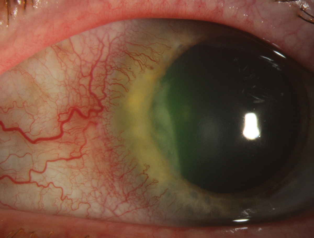 drgunjand's tweet photo. PUK

Pathophysiology:
Immune complex deposition in limbal vasculature.
Leads to vasculitis → ischemia → stromal melt.
Upregulation of collagenases → corneal thinning and perforation.

#MedTwitter #ophthalmology #neetpg 
Image from google
