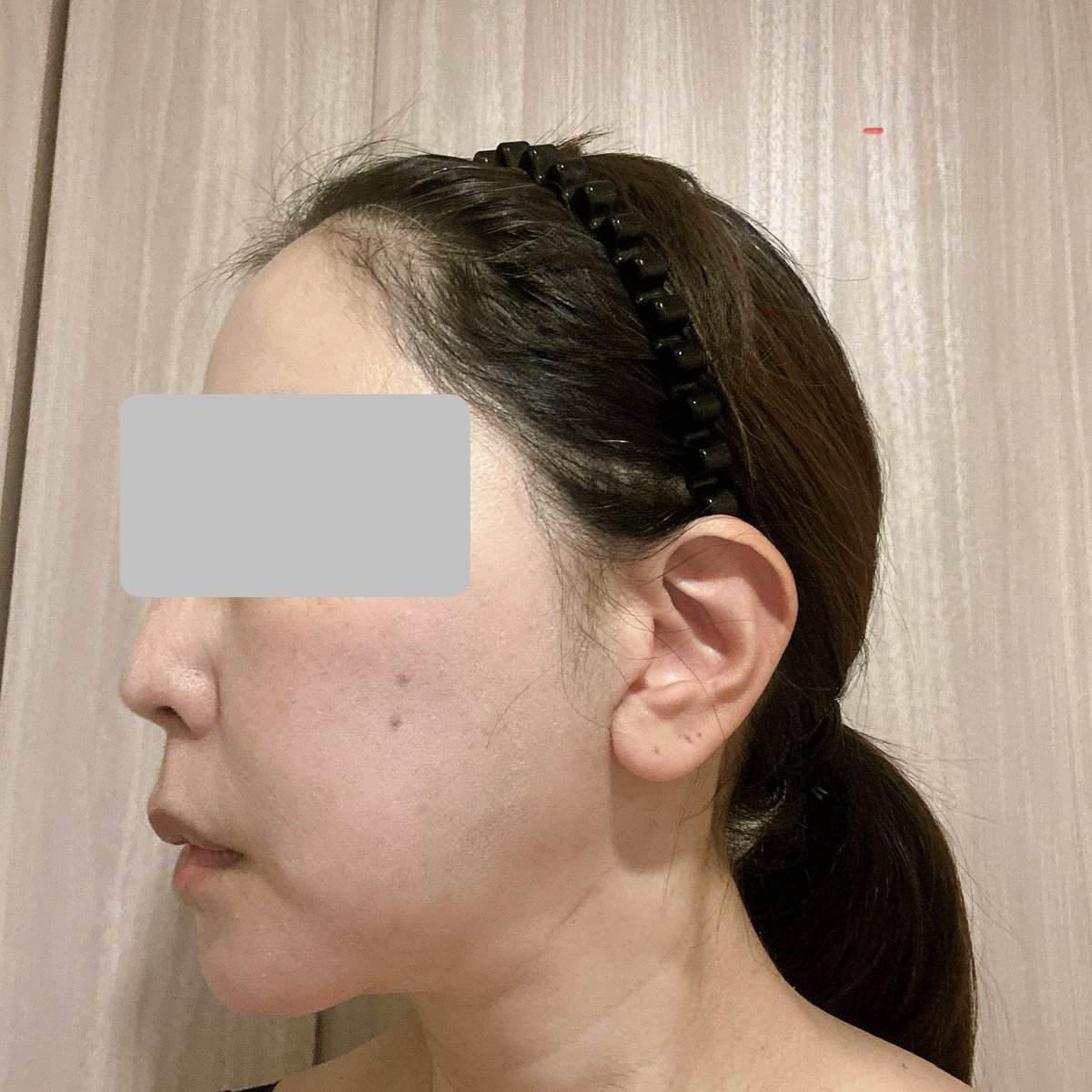 Momoko_Lopez's tweet photo. 【切開リフト6ヶ月】9割くらい腫れが引いた感じ。顔がシュッと小さくなっだと思う！ほうれい線や口横の凹みには先生にフィラー入れてもらって解決😃今の感じとても気に入ってる✨めちゃ若がえった！ https://t.co/IdpO6XzKqB