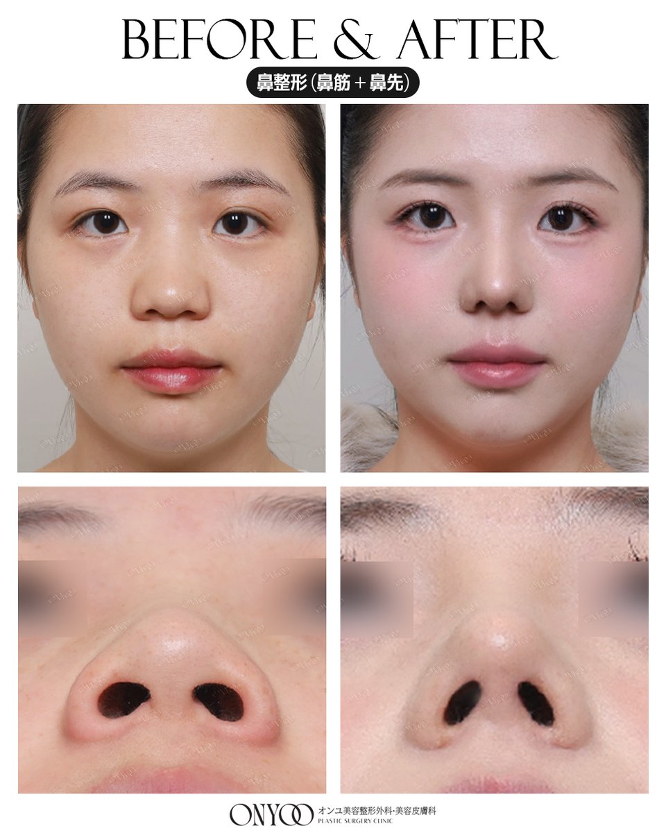 オンユ美容整形外科・美容皮膚科 【額縮小/挙上/リフトアップ】専門🎖 tweet media