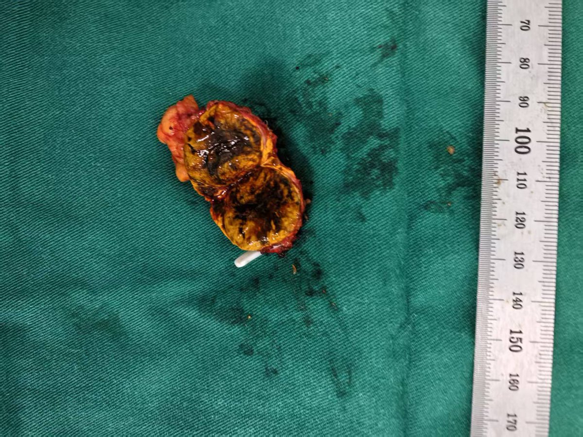 jerry54131's tweet photo. I performed four retroperitoneal laparoscopic adrenal tumor resections, one laparoscopic radical nephrectomy, and one Da Vinci robotic partial nephrectomy. Today, I have fully recovered with abundant energy. https://t.co/Dn2Epi5VoA