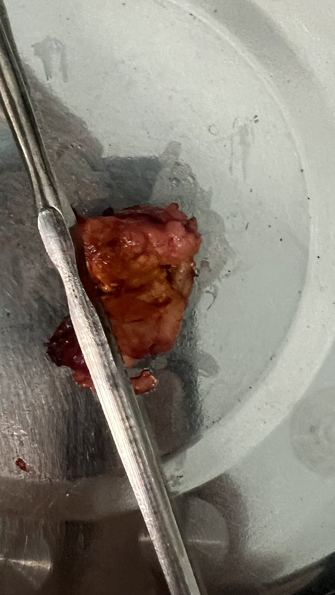 jerry54131's tweet photo. I performed four retroperitoneal laparoscopic adrenal tumor resections, one laparoscopic radical nephrectomy, and one Da Vinci robotic partial nephrectomy. Today, I have fully recovered with abundant energy. https://t.co/Dn2Epi5VoA