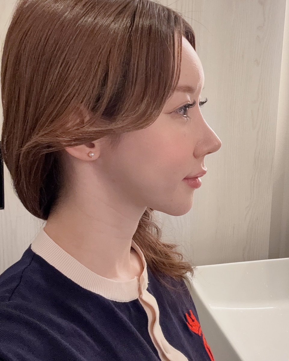 整形ぱんだ🐼ポニーテールリフト、脂肪移植DT中 tweet media