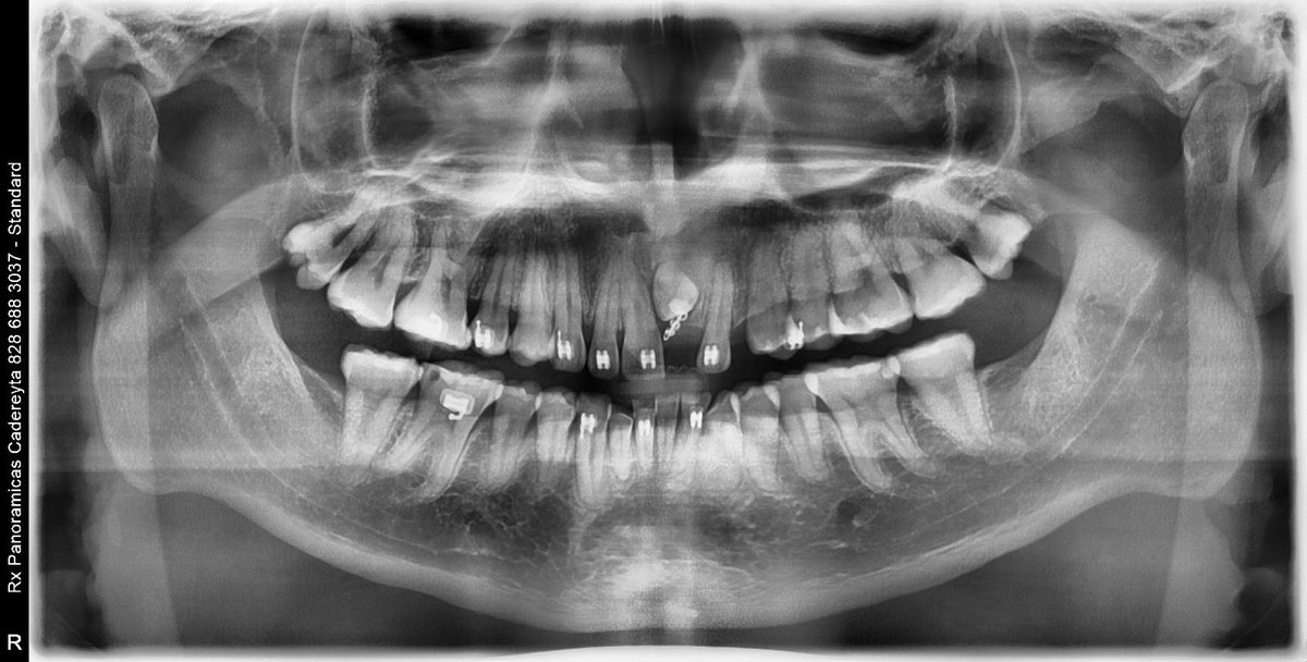 Tomas_Or13's tweet photo. He pasado por dos dentistas que solo me han hecho perder dinero y tiempo,quiero saber ahora qué pasa, me quitaron un central y un colmillo, tengo un diente que nunca bajo que querían hacerlo que bajara con un botón con cadena a los brackets.. y hacerle la forma a central, los leo https://t.co/gmxcQRrcSS