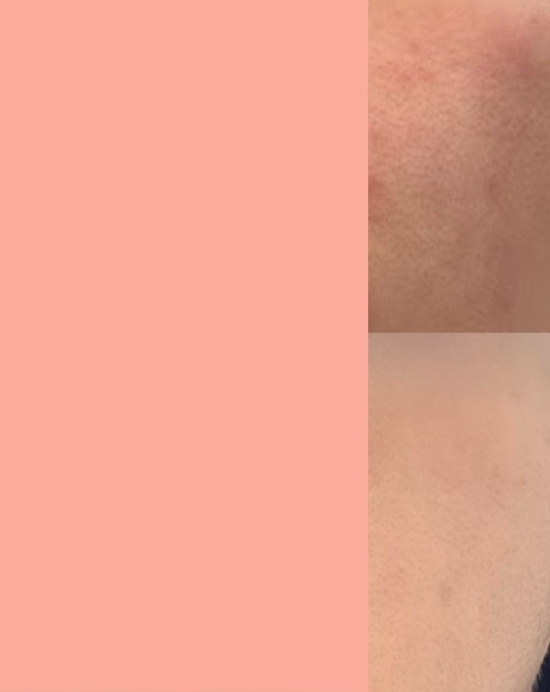 ✨뒤집어진 피부 5일만에 복구한 Tip✨

올리브영 가지말고 기초를 싹 끊어보십셔
갖고있는 장벽이나 보습 ‘크림만’ 일주일간 바르는것임! 피부과 대부분 뒤집어진 피부에 스킨, 로션등 물제형 기초 끊기부터 처방함(화장금지는 디폴트) 건조하면 하염없이 크림만 덧발랐고 현재 싹 나았어요