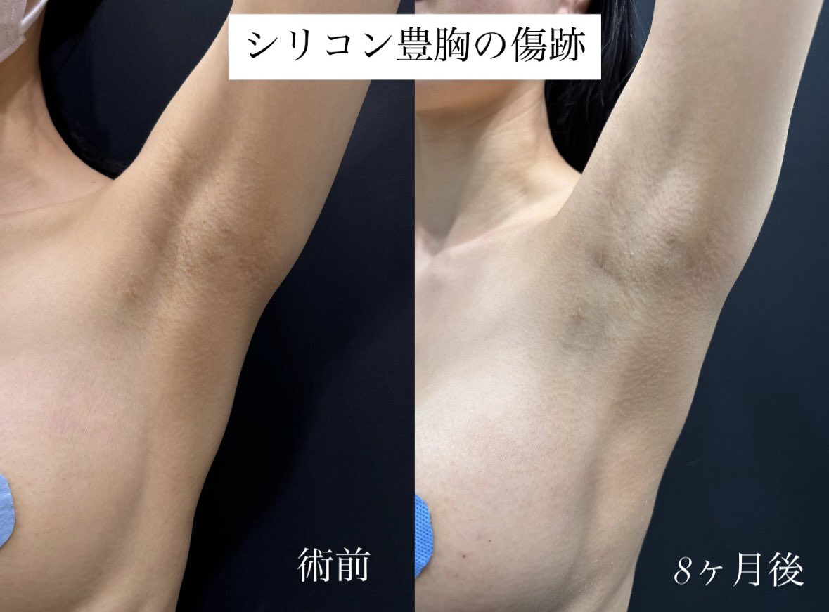 dr_gibo_'s tweet photo. 【ハイブリッド豊胸が向いてる人の特徴5選】

①一度で3カップ以上大きく、自然さも欲しい
② 超痩せ型(脂肪注入だけだと渋い)
③バージスラインを大きく下げたい
④授乳後の下垂と削げが大きい
⑤シリコン挿入に精神的な抵抗がない

ハイブリッド豊胸の料金 (モニター価格)
・Motiva エルゴノミクスⅡ × アキーセル併用コンデンスリッチ脂肪豊胸 173万円
・メスモ × アキーセル併用コンデンスリッチ脂肪豊胸 132万円