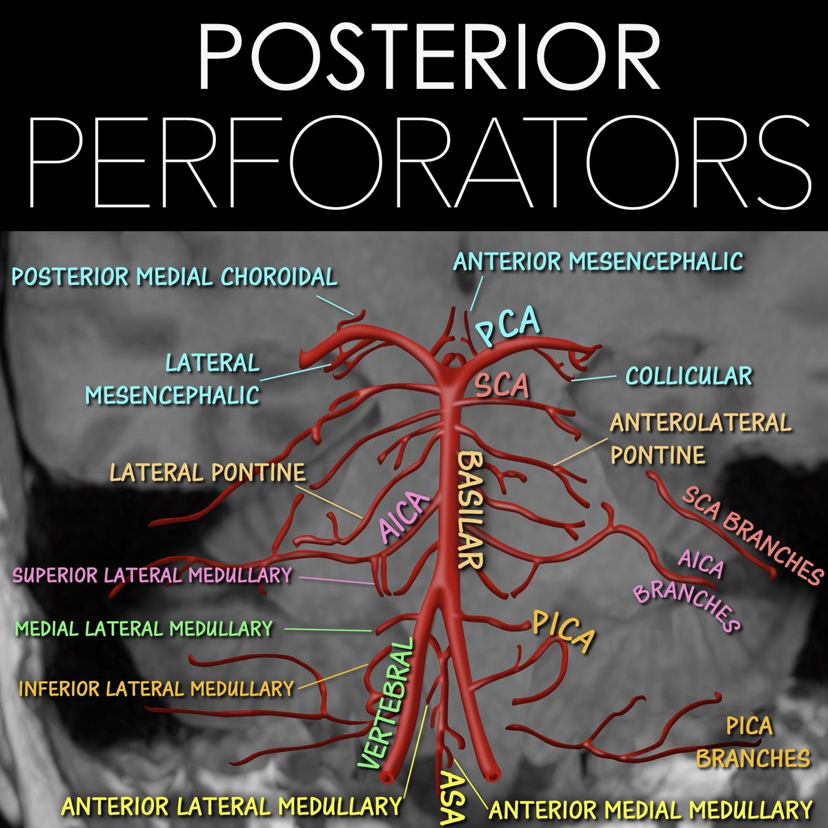 teachplaygrub's tweet photo. In medicine, anatomy is power!
 
It helps diagnose & treat disease--but you must know it first!
 
Posterior fossa perforator branches are key in stroke. How many do YOU know?
 
Here's a color-coded map of the perforators for each, an easy reference guide to help you branch out!
 
Key points:
 
Here are the 3 main syndromes associated with occlusion of these perforators & some quick tips to remember classic signs:
 
—Low (proximal) occlusion:
Contralateral hemiparesis—I remember this because the low basilar is right by the vertebral arteries.  So I remember cutting off ONE of the legs
 
CN 6 deficit:  Here is where the vertebral arteries are moving towards the basilar at midline—so a deficit here will cause your eye to move towards midline with a CN6 deficit
 
—Mid occlusion:
Quadraparesis—I remember this bc cutting the basilar at the mid portion looks like cutting someone in half at the trunk.  Neither leg will move after that!
 
Corticobulbar signs—Basilar is long like an esophagus.  Cutting esophagus in half = can’t swallow = bulbar symptoms
 
—High occlusion
Contralateral hemiparesis—I remember this bc the top of the basilar is near the PCAs, which look like arms.  So I remember cutting off ONE of the arms
 
PCA symptoms—bc it’s right by the PCAs!
 
Parinaud’s (upward gaze palsy)—PCAs are heading UP from the basilar towards the VISUAL cortex.  So if you occlude them, you can’t go UP with your EYES!