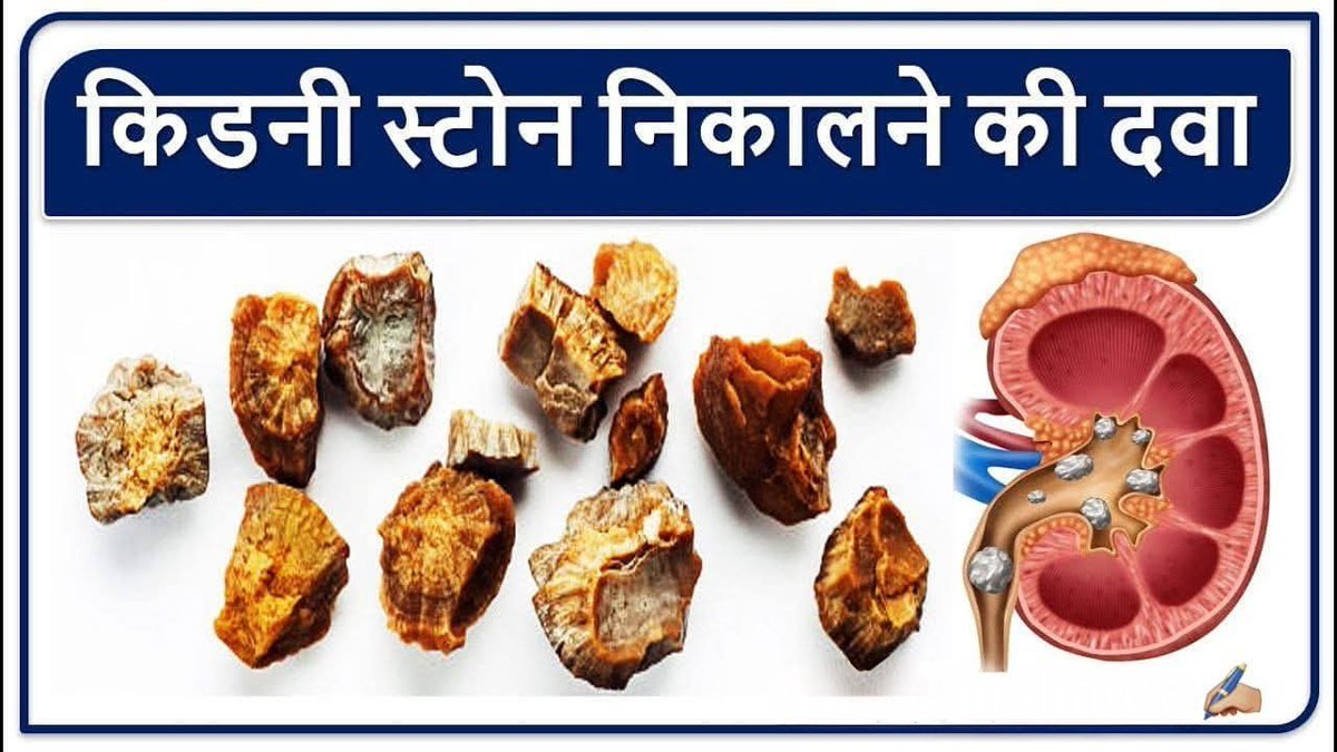 मूत्ररोग एवं पथरी की अचूक चिकित्सा
कुछ चमत्कारी उपाय पढ़ें और सहेज लें 👇

(💾 इसे सेव कर सुरक्षित कर लें, 
 ऐसी पोस्ट बार-बार नहीं आती...)

बहुत ही ज्ञानवर्धक लेख  2 मिनट समय निकालकर Thread अंत तक जरूर पढें.... 🧵👇