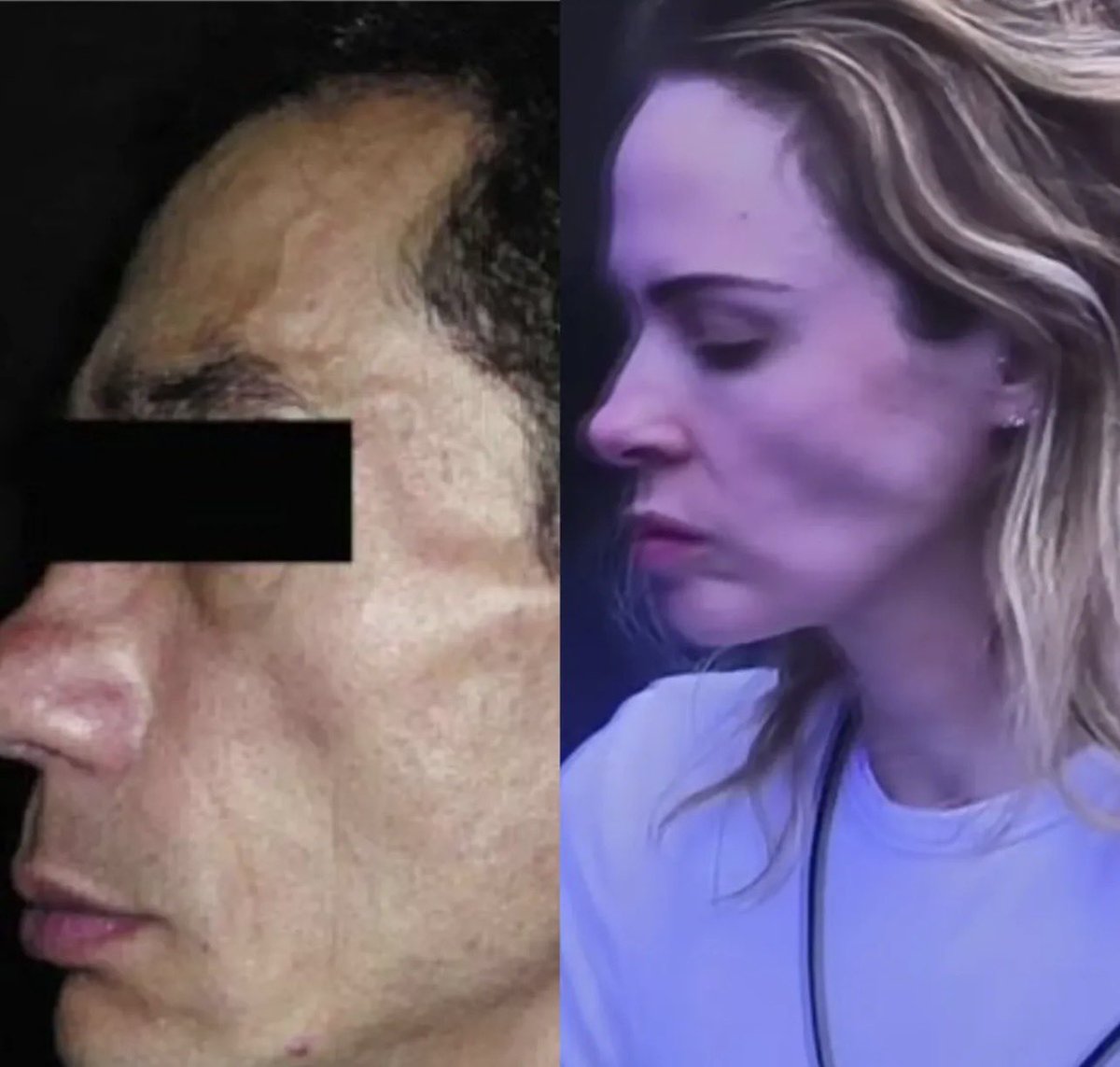 VAMOS TER QUE FAZER UM INFERNO NESSA REDE DE NOVO?

Esse ‘sinal da asa quebrada’ não é estética, não é fase e muito menos ‘conteúdo’: é Desnutrição proteico-calórica grave. É corpo sem recurso, músculo indo embora, gordura desaparecendo, inclusive a bola de Bichat, deixando esse