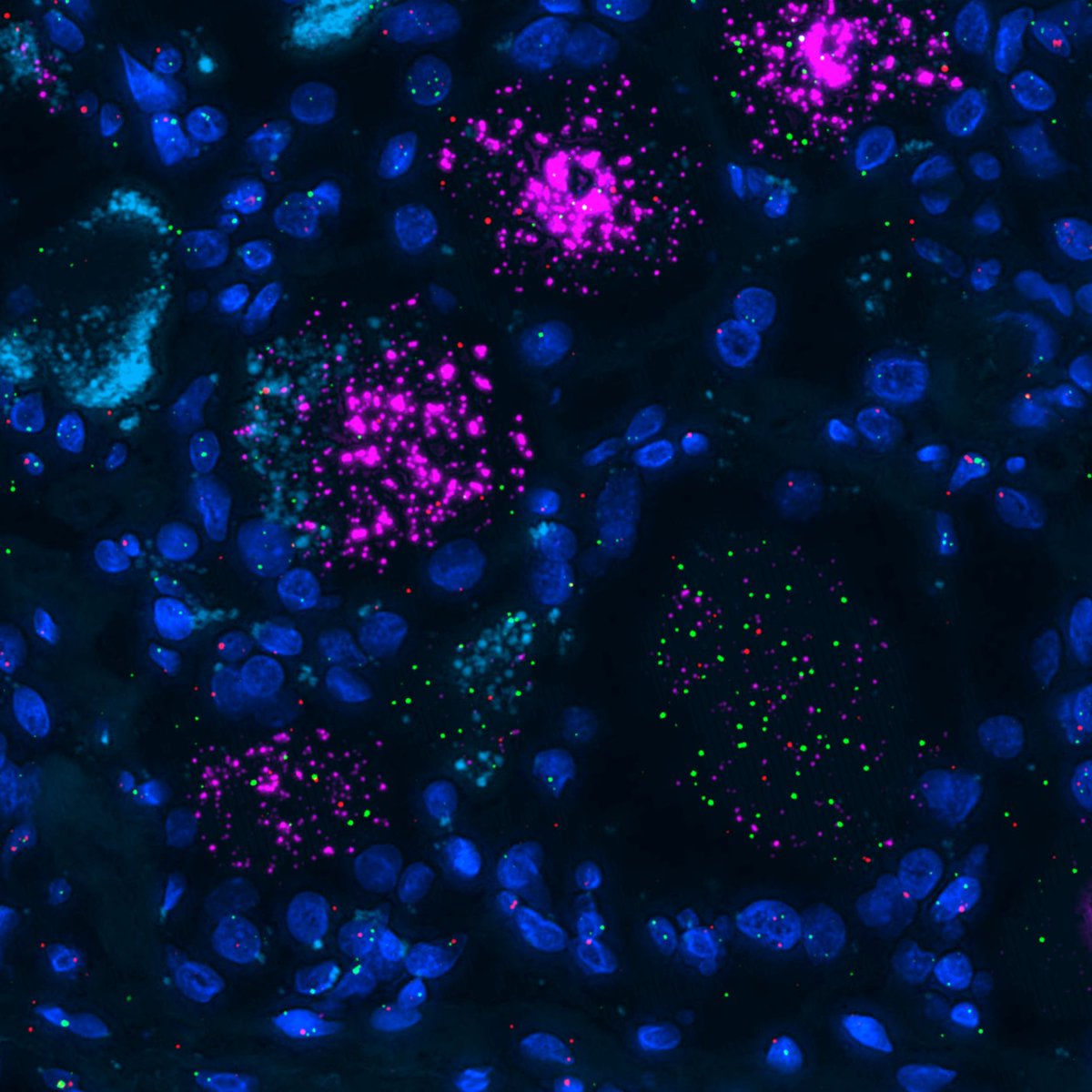 OffspringBioAB's tweet photo. A view into the human dorsal root ganglia with 3-plex ISH.

We're mapping drug target expression (🟢,🔴) directly in nociceptive neurons(🟣). This level of precision is critical for developing new therapeutics in #Neurology

#InSituHybridization #Histopathology #PainResearch https://t.co/QLnxntnhk7