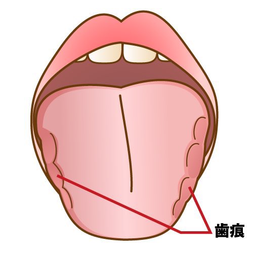 s_matuzaki's tweet photo. こんなギザギザの舌をしてる人は栄養的に見ると「たんぱく質不足」を疑ったほうがよくて、血液中のアルブミンというたんぱく質が不足して血管外に水分が漏れ出してる状態。舌がパンパンにむくんでるから歯の跡が残りやすくなる。あとはマグネシウム不足でも過緊張から食いしばりが起きて舌に跡がつくこともある。

舌は「むくみと栄養状態」を表す指標になる。たんぱく質、マグネシウム、カリウムあたりの不足がないかを確認することと、甲状腺機能低下でも浮腫みから舌がギザギザになることがあるのでご注意を。
