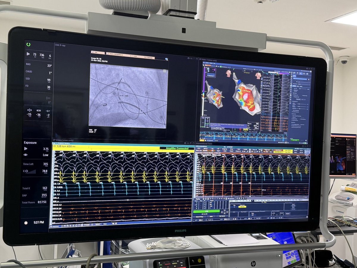 atolat3's tweet photo. Itβs the end of wk and workshop at UN Mehta Cardiac Institue Ahmedabad India, with over 1250 beds one of the largest. learned a lot made new friends. We performed an isch VT abl Entrainment, with RF Term #AblateVT. EP brought us together, look forward to next yr π https://t.co/wCkaP1aePv