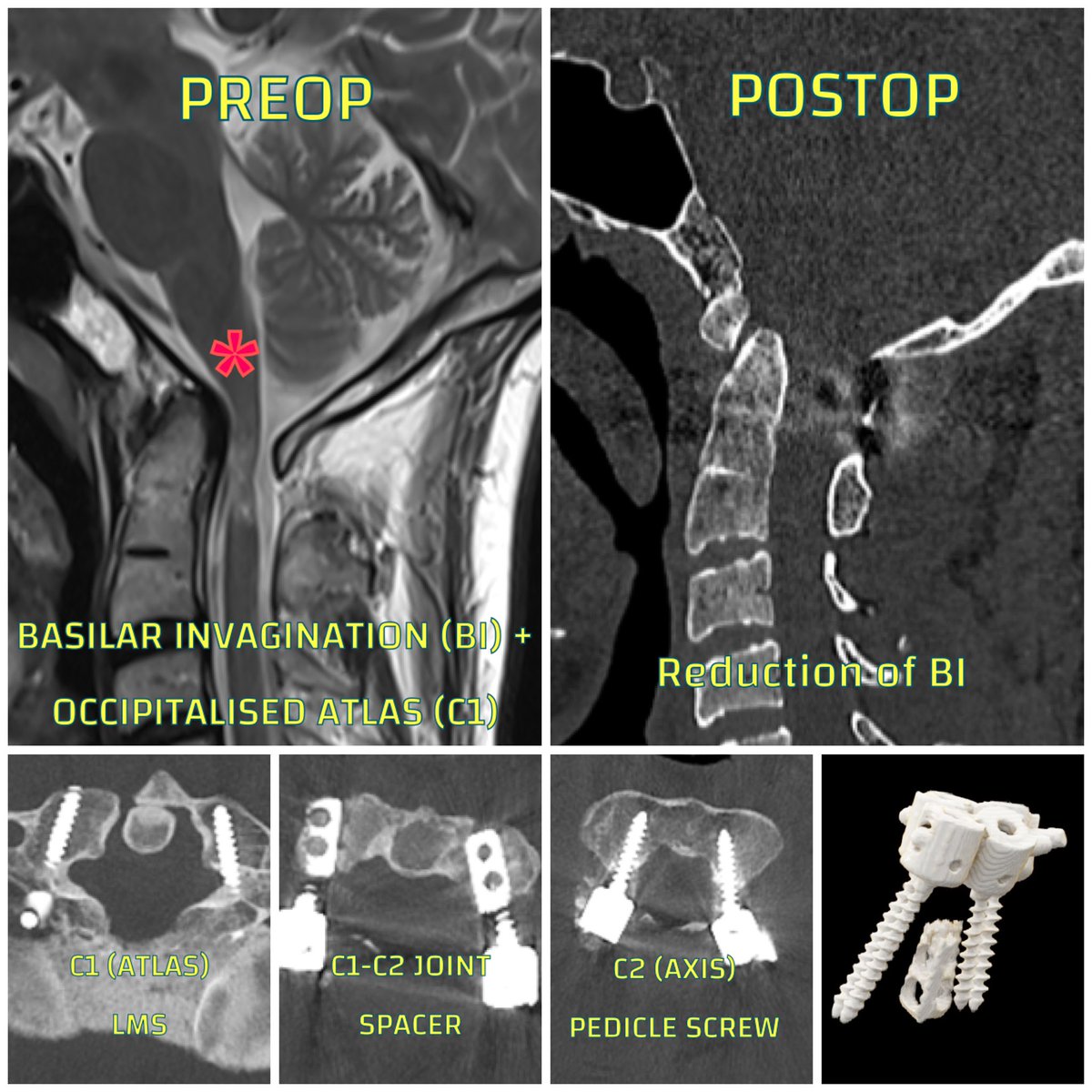 KothiwalaNeal's tweet photo. 🔔 CVJ ANOMALY 
( BASILAR INVAGINATION causing Brain stem and cervical spinal cord compression) 

Surgery - C1-C2 FUSION  AND BI REDUCTION USING C1-C2 Joint Spacers)

Young Male presented with progressive spastic Quadriparesis made good neurological recovery after surgery. https://t.co/BHKQhnaoKj