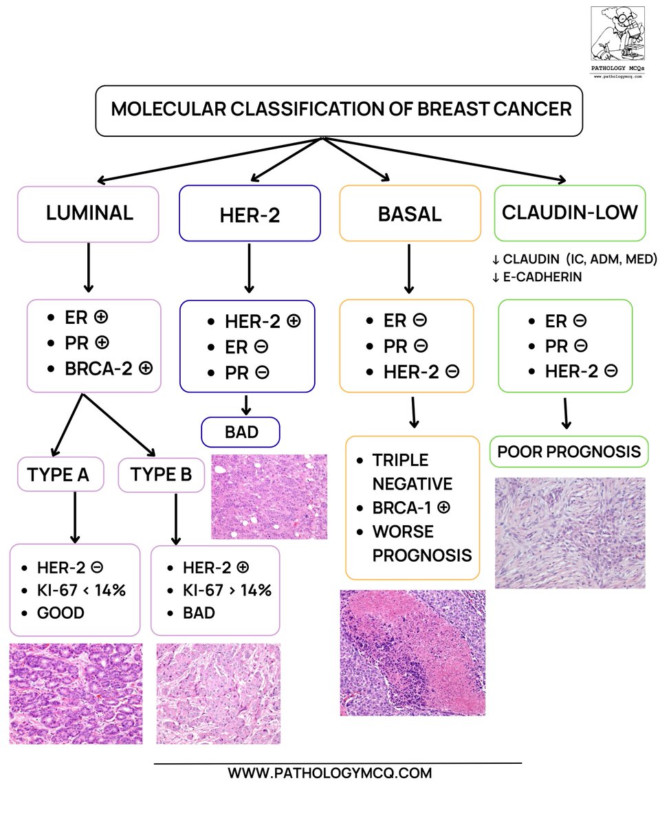 🔬✨ Molecular Classification of Breast Cancer — Made Visual &amp; Easy

🧬 From hormone-driven luminal tumors to aggressive triple-negative and claudin-low variants, this chart connects IHC profile + morphology + prognosis in one glance.

#Pathology #BreastCancer #MolecularPathology