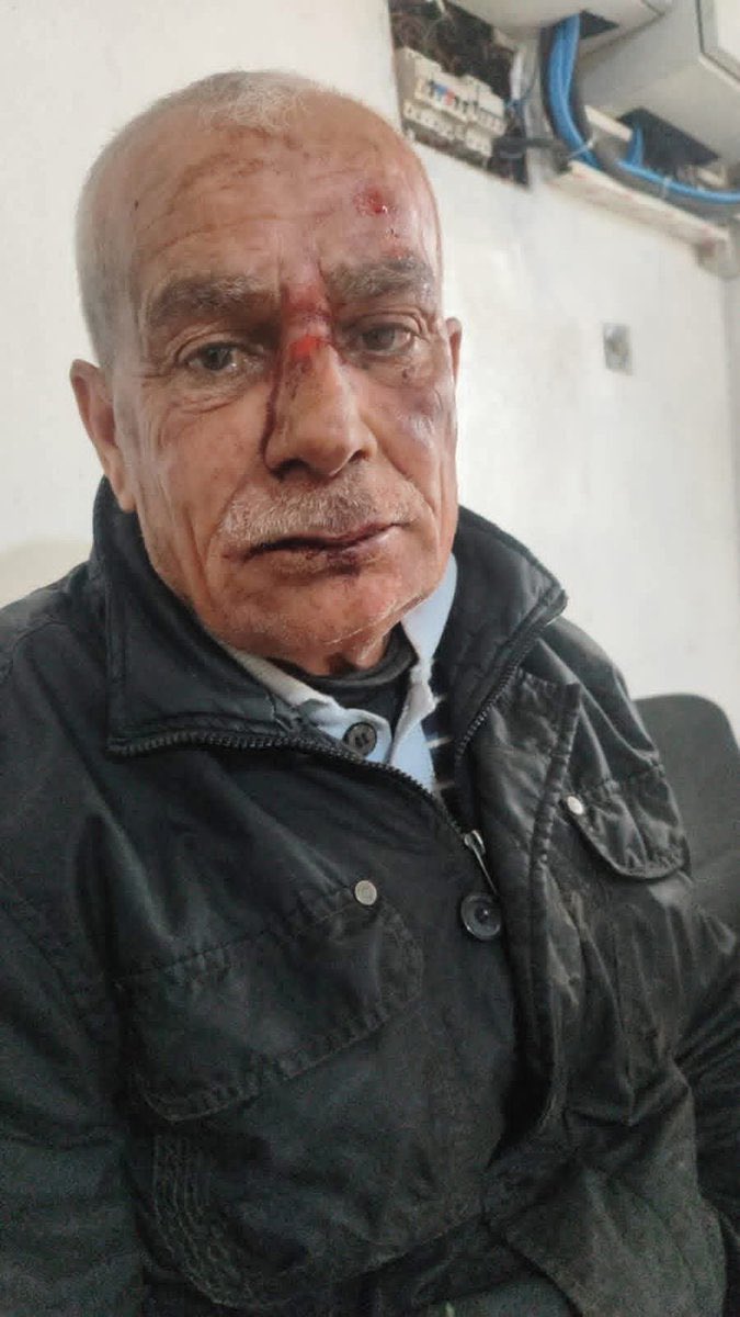 NebilYousif's tweet photo. Afrin – In the lead-up to the Newroz Day, reports have emerged of continued violence and intimidation targeting local residents in the region.

According to local sources, unidentified individuals assaulted taxi driver Mohammad Omar, also known as Mohammadi Kali, a resident of the village of Jweik. The assailants reportedly hired him under the pretense of requesting a ride, before attacking him and fleeing the scene.

The victim was later transported to Dersim Hospital in Afrin, where he is currently receiving medical treatment.

The incident highlights ongoing security concerns in Afrin, particularly amid recurring reports of attacks against civilians.
#NewrozPîrozBe #Newroz #Afrin #Kurds #KurdsOnAlert