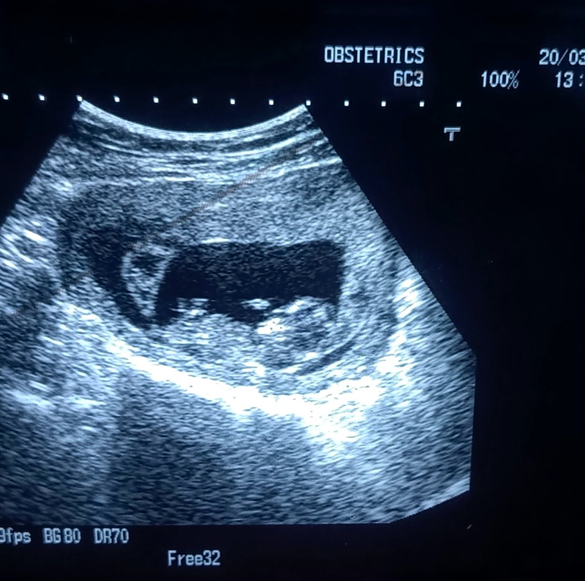 Viable and active fetus. 

Can you spot anomaly here?