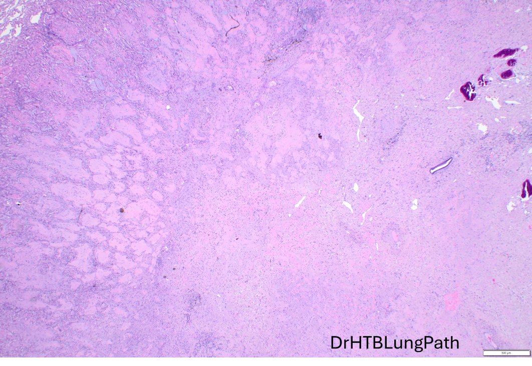 Humberto Trejo Bittar, MD, FCAP tweet media