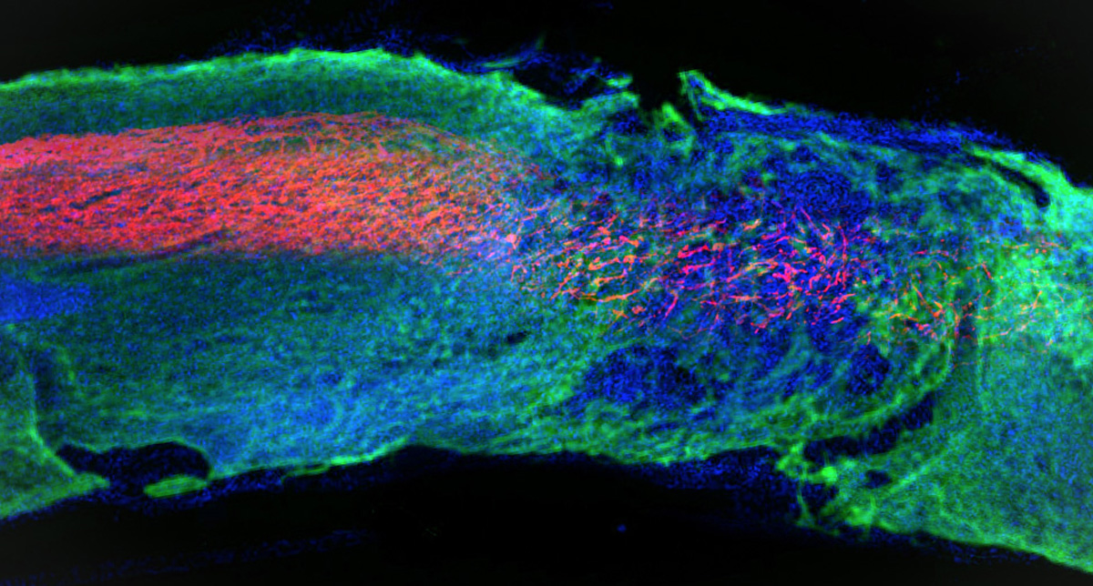 NMNeurology's tweet image. In study results published in #Neurotherapeutics, Northwestern Medicine scientists have developed an injectable regenerative #nanomaterial that helps protect the brain during the vulnerable window after a patient has a #stroke.

Read more about the treatment: