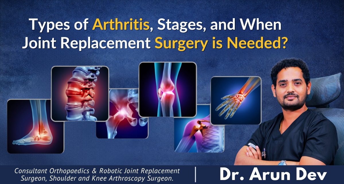 DrArunDev_Ortho's tweet photo. Check out the latest article in my newsletter: Types of Arthritis, Its Stages, and When Joint Replacement Surgery Becomes Necessary? https://t.co/GMf5Y3LuMc via @LinkedIn https://t.co/zBmt8MUQ1B