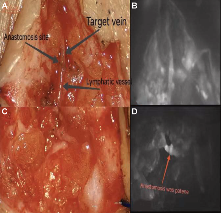 JVS - Venous and Lymphatic Disorders tweet media