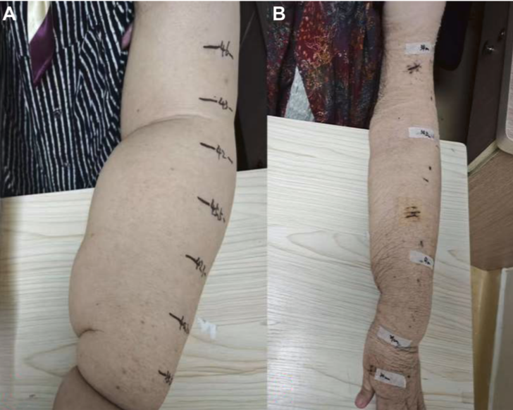 JVS - Venous and Lymphatic Disorders tweet media