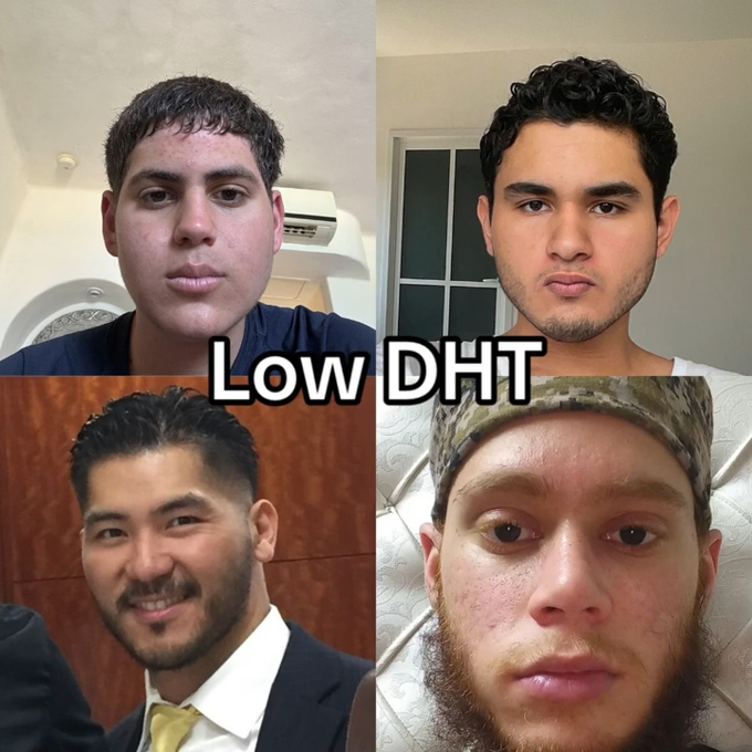 High DHT makes you look more masculine. Low DHT? You look softer ...