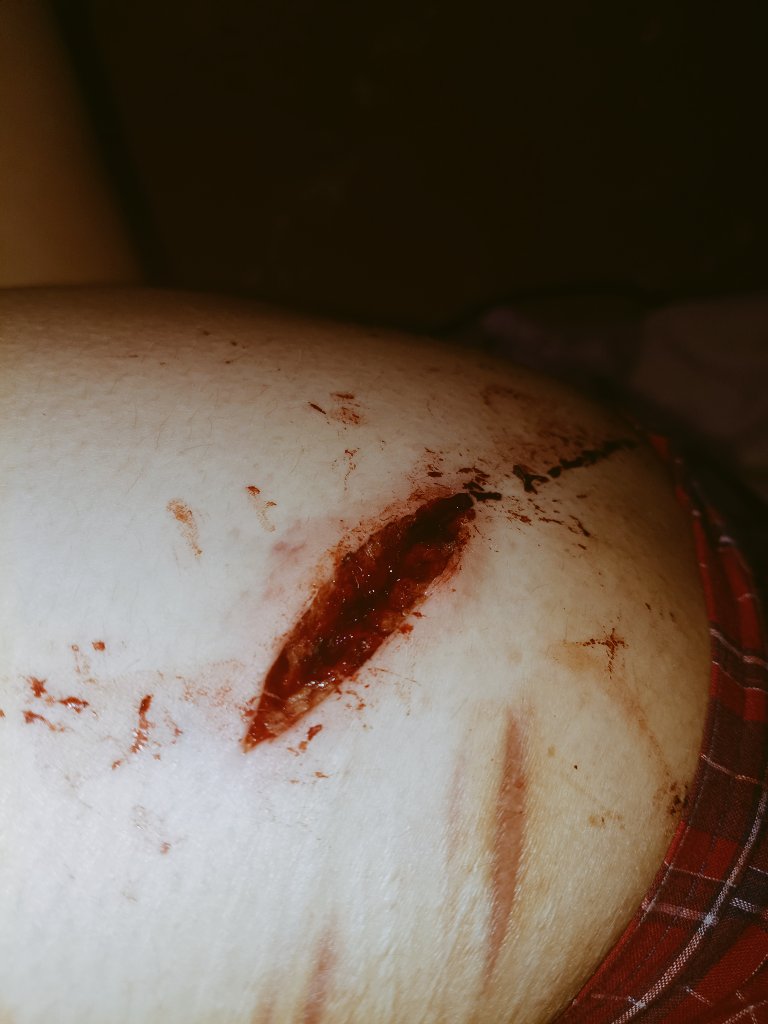 sofistudys's tweet photo. Otro chiquito,pero este sangro demasiado pensé que había tocado vena pero el imposible #shtwt #beans https://t.co/ttboSEa5Yw