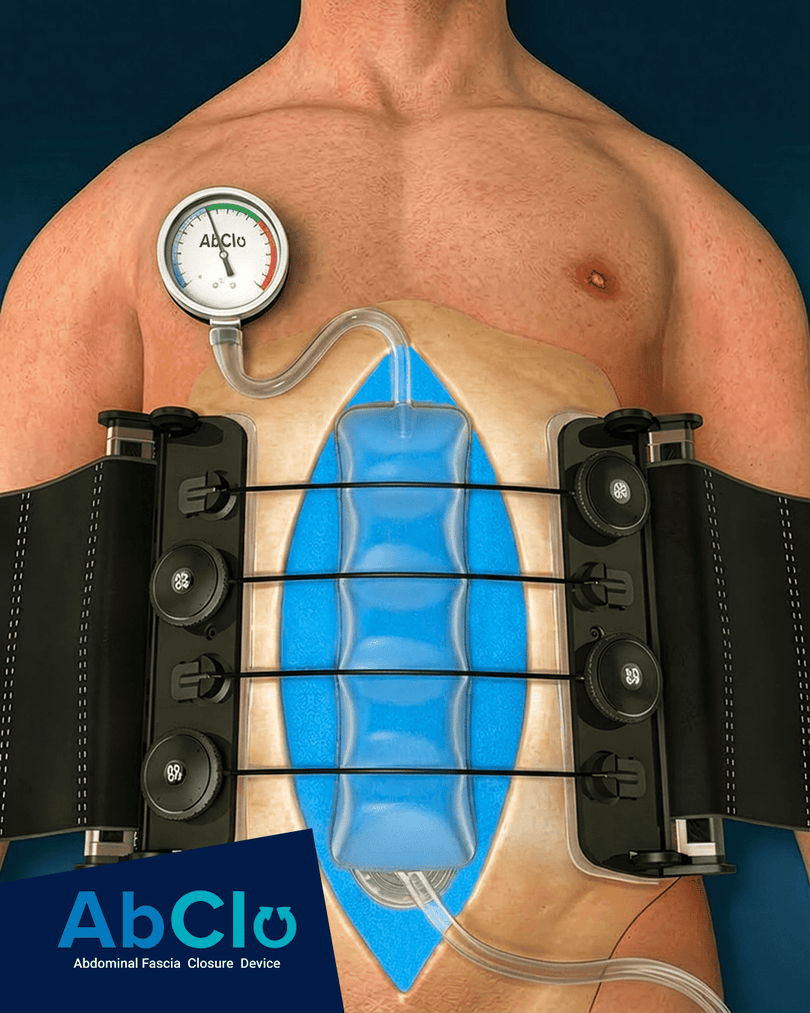 InventorrMD's tweet photo. Surgical Care: beyond survival, it's about quality of life. AbClo™ protects the abdominal wall, enabling stronger fascial closure to help patients avoid incisional hernias &amp; chronic wound issues.

Learn how it works: https://t.co/WqVfUFEmld

#AbClo https://t.co/vntvN7wQEU