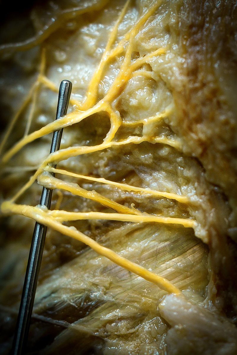 TorresKine's tweet photo. Títol: Anatomia d’un somriure
La fotografia documenta les branques frontals i zigomàtiques del nervi facial emergeixen després d’hores de dissecció. Sota la pell, una trama delicada fa possible tancar els ulls i somriure. @cienciaURV @universitatURV 
#general
#FotoRecercaURV2026 https://t.co/dKKiRI0Db8