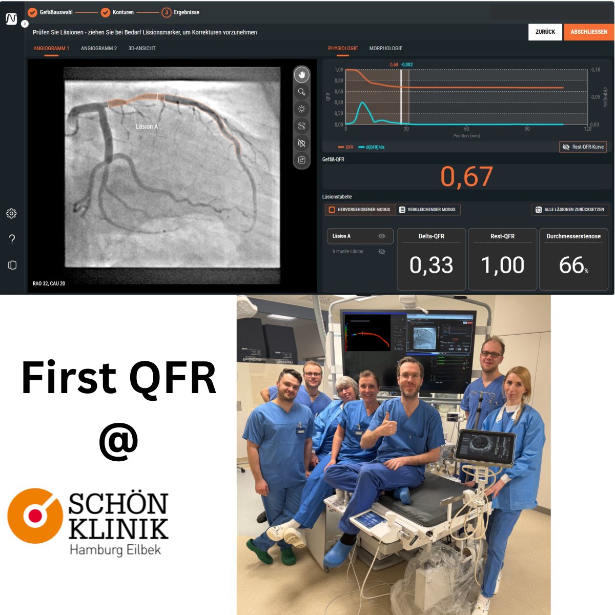 KardiologieHH's tweet photo. From #Anatomy to #Physiology
Taking #PCI to the #NextLevel ⬇️
We at Schön Klinik Hamburg Eilbek are proud to be the first centre in Germany to successfully implement Medis Medical Imaging #QFR 3.0 into our daily cath lab workflow.
#InnovationFirst https://t.co/9mNJGl4yZm