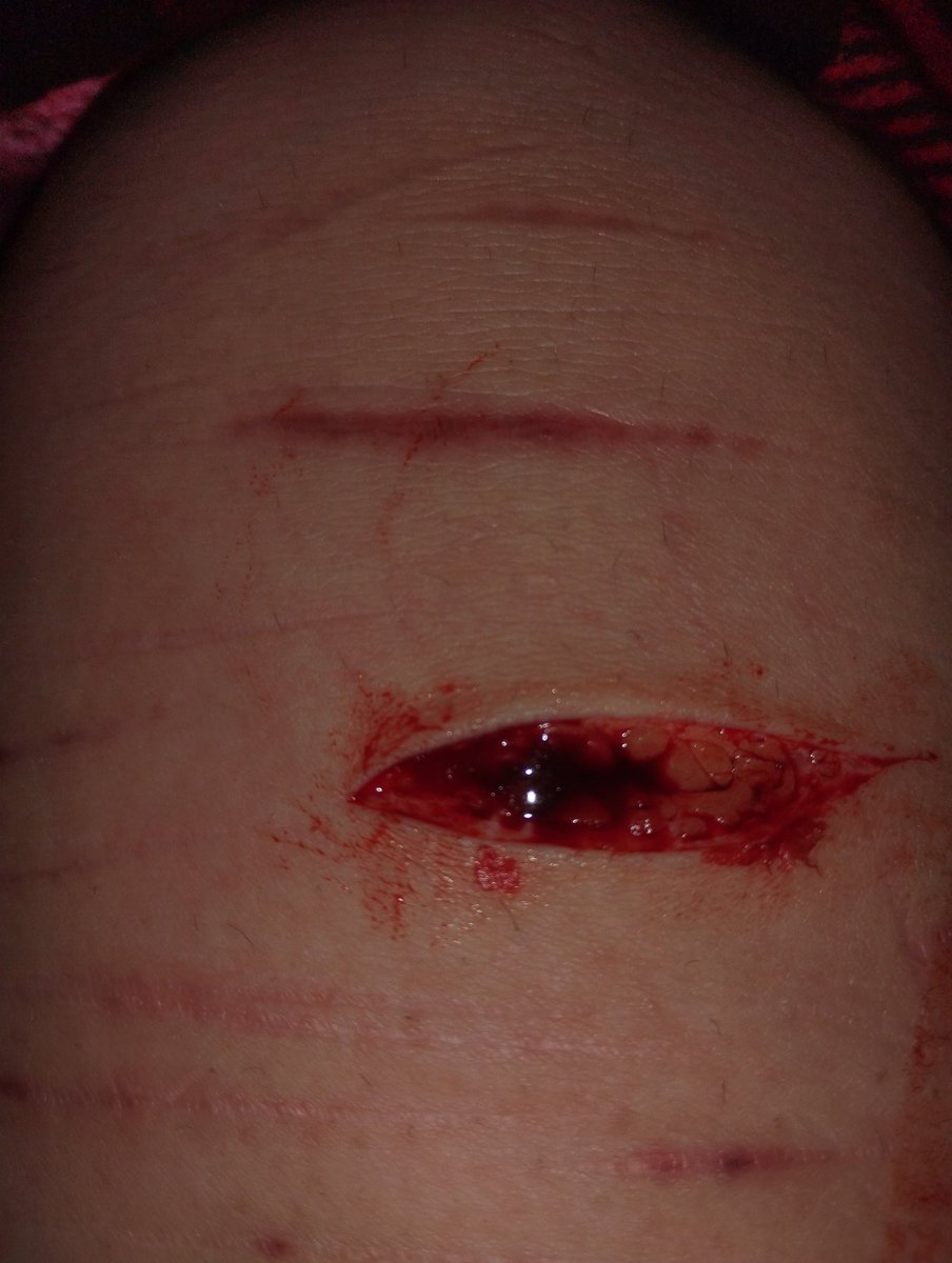 MorenoLuvr's tweet photo. Sesh #Shtwt #Shedtwt #edtwt #beanstwt #beans #sh #shh #shsesh #shbeanssesh #beens #selfharm #goretwt https://t.co/je2aFIVgdu
