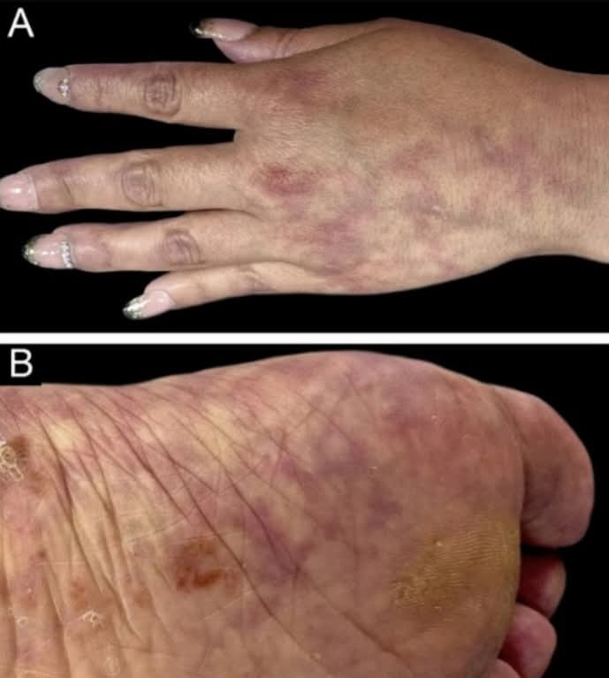 albertoortegana's tweet image. A young woman presents with recurrent transient ischemic attacks. Skin examination shows the vascular pattern seen in the image. What is the most likely diagnosis?

#medico #medlife #medschool #medstudent #derma 
#MedTwitter #FOAMed #MedX
@dr_manish_ydv @Dr_Shiv_kumar_ @DrAkhilX