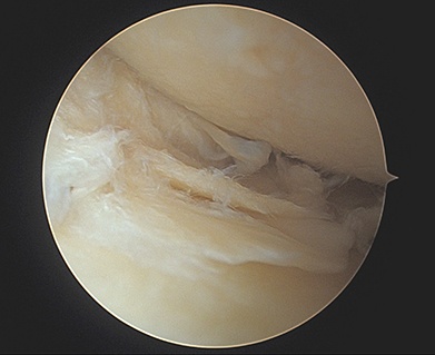 jonwatsonmd's tweet image. #meniscustear can also be degenerative in nature, or associated with #kneearthritis . In these cases the tear was often caused by the arthritis, and it is more important to treat the arthritis symptoms with modalities such as injections, PT and medication. #skylineorthopedics