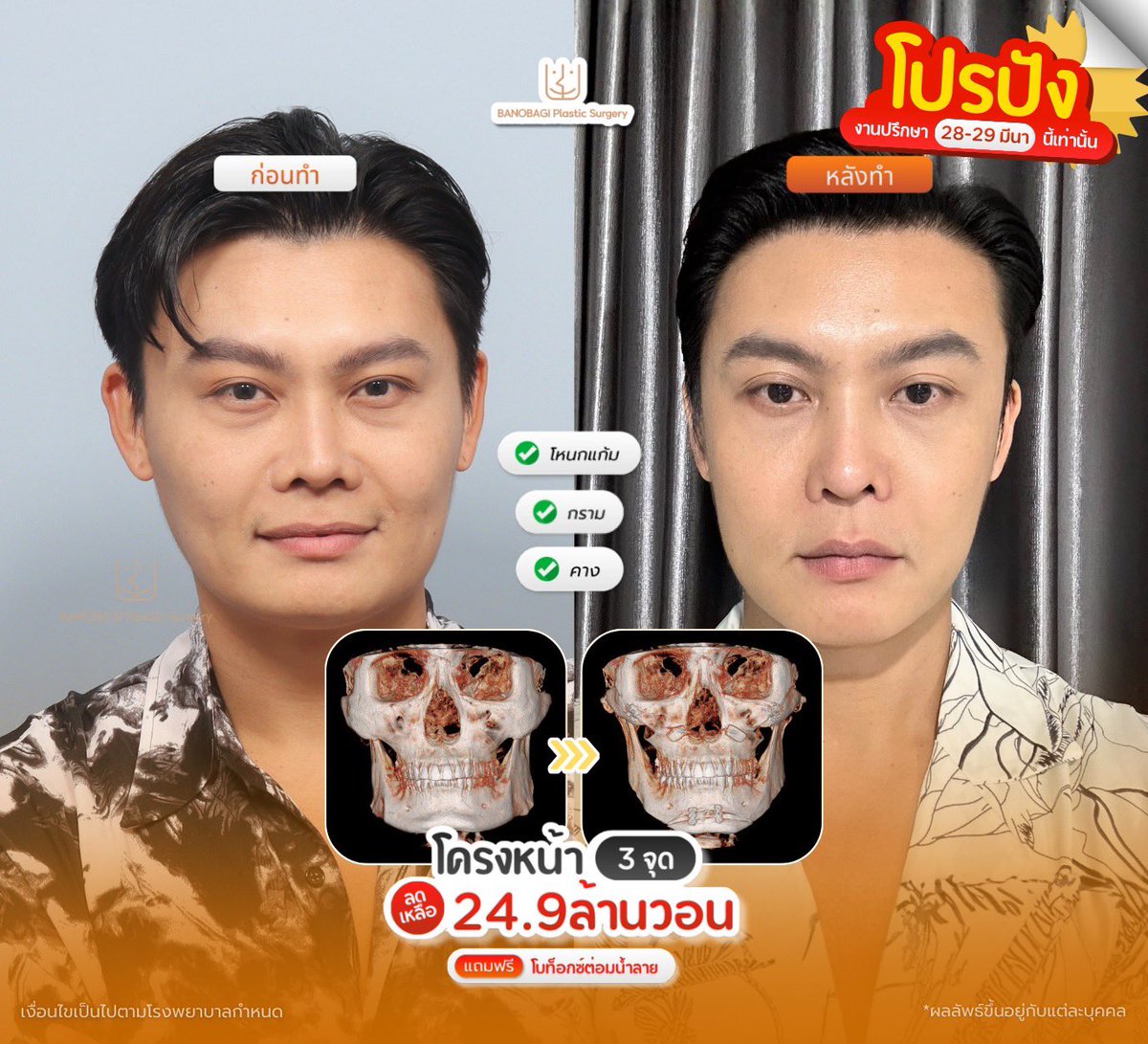 banobagithai's tweet photo. โครงหน้าปัง โปรก็ปัง 📣‼️
เปลี่ยนลุคให้ละมุนขึ้นในโปรเดียว~

🎟 โปรพิเศษ 28–29 มีนาคม 2026 นี้เท่านั้น
ค่าปรึกษา 1,000 บาท

🔸 โครงหน้า 3 จุด เหลือ 24.9 ล้านวอน + Free! โบท็อกซ์ต่อมน้ำลาย
🔸 โครงหน้า 1 จุดขึ้นไป ลด Triple Tite 50%

#ศัลยกรรมเกาหลี #โครงหน้า #ยกคิ้ว #ยกกระชับ https://t.co/rgIFxudBAj